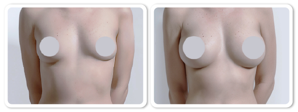 Augmentation of berasts clinical test before and after photos