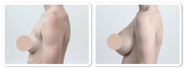 Augmentation of berasts clinical test before and after sideview photos