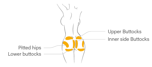 Pitted hips, Lower buttocks, Upper buttocks, Inner side buttocks