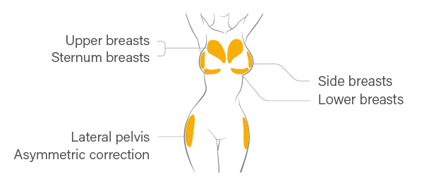 Upper breasts, Sternum breasts. Side breasts. Lower breasts. Lateral pelvis. Asymmetric correction.