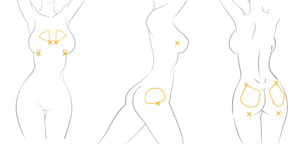 LEXYFILL bodyfiller typical injection site