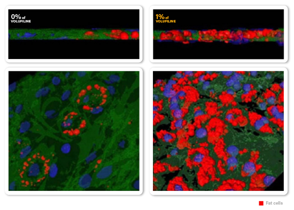 VOLUFILINE™ 0%, 1.0% Concentration clinical studies(fat cells MRI photo)