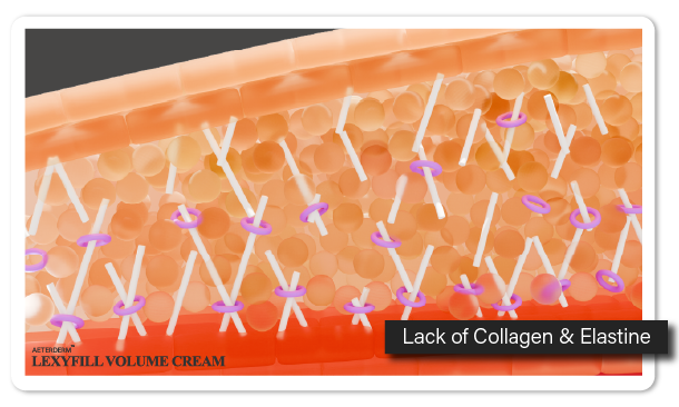 The sudden increase in dermal volume caused by HA filler disrupts the structure of collagen and elastin. Lack of Collagen & Elastine.