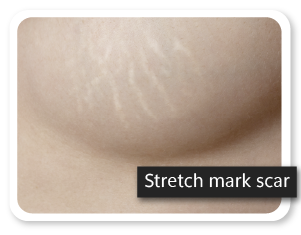 Skin stretch mark scar on the breast
