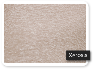 Skin xerosis image